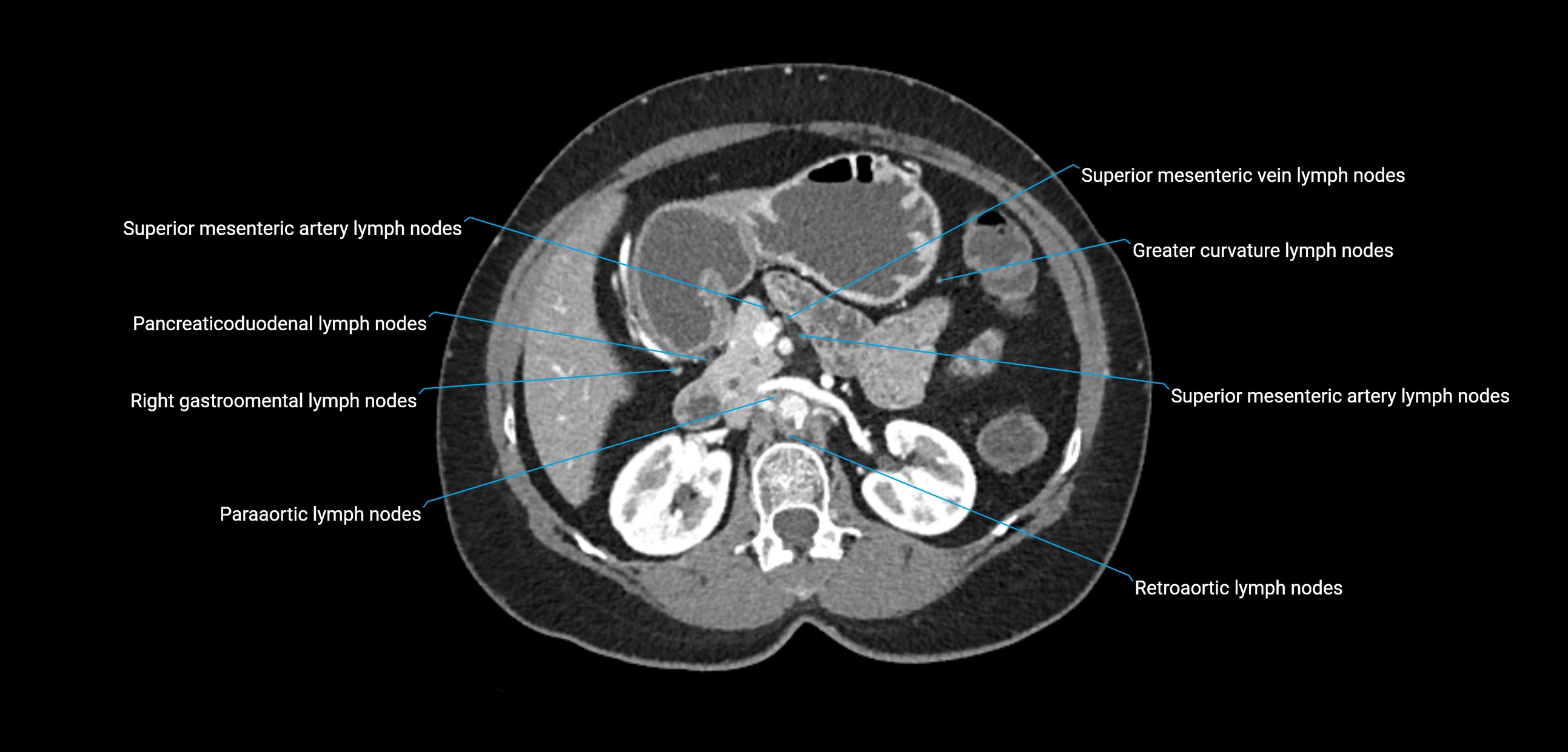 CT ct abdominal lymph nodes  axial cross sectional anatomy  enchanced radiology image -img-00002-00169.webp
